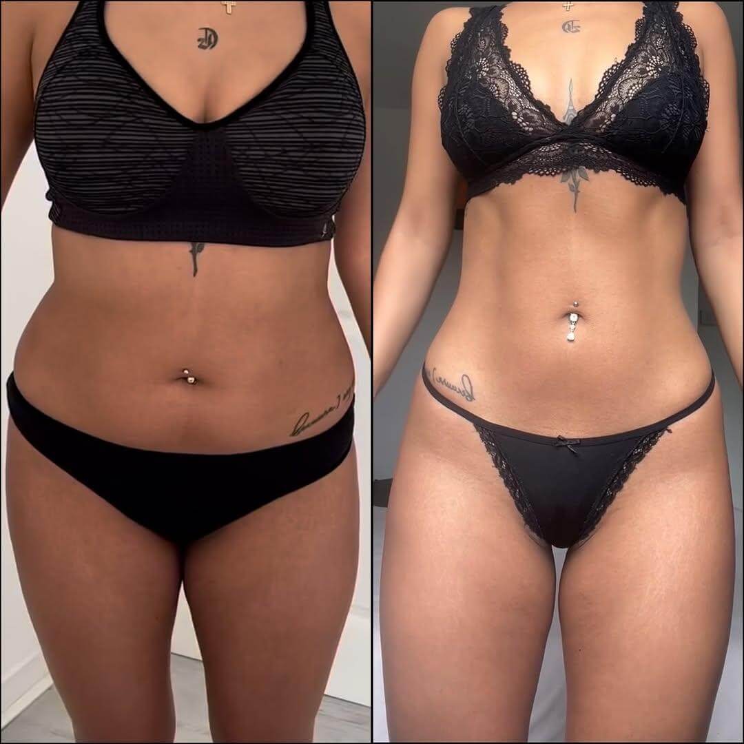 Harmonização-corporal-dra-ana-flávia-freesz