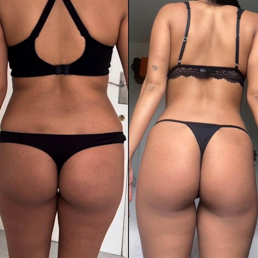 Harmonização-corporal-feminina-juiz-de-fora-dra-ana-flávia-freesz