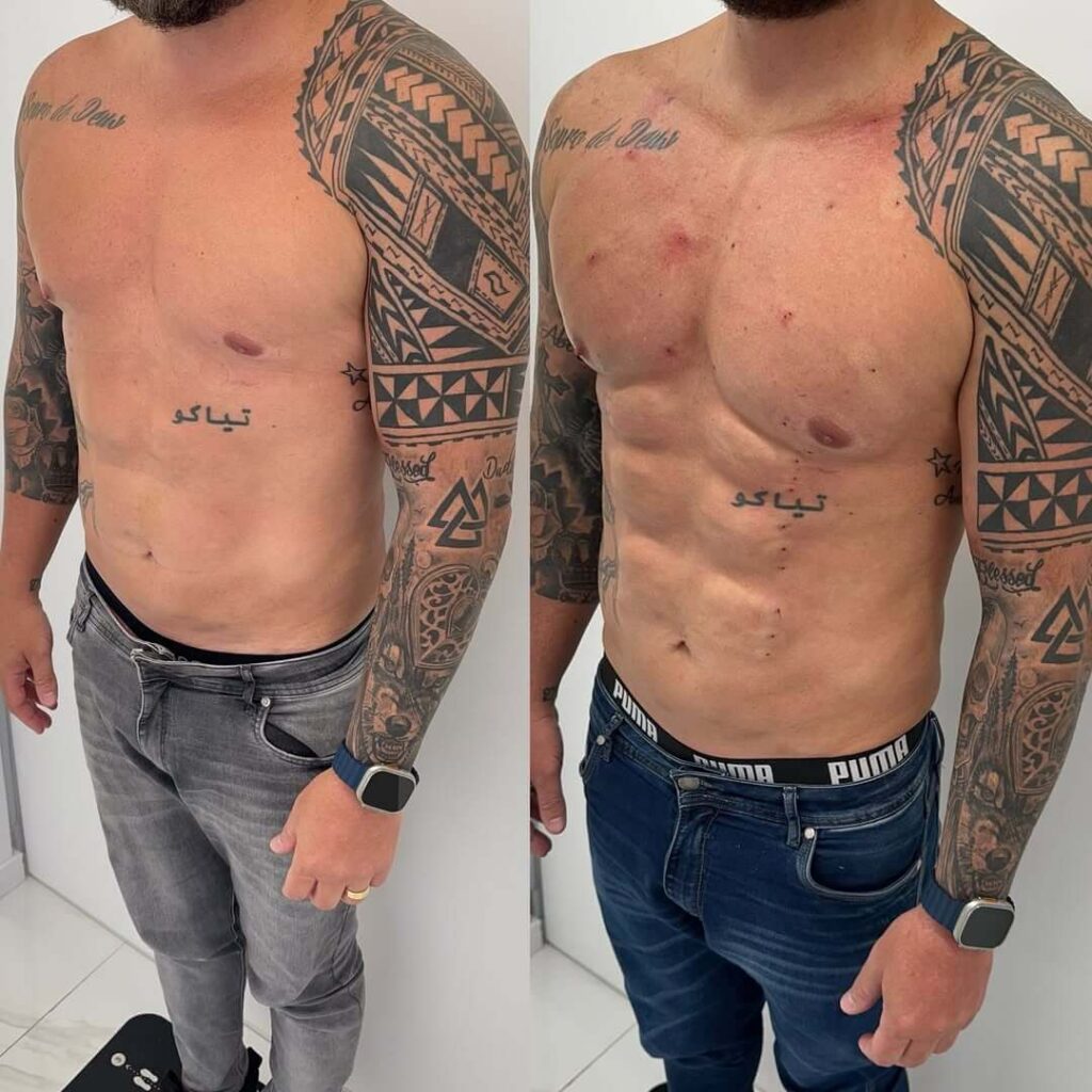 Harmonização-corporal-juiz-de-fora-dra-ana-flávia-freesz