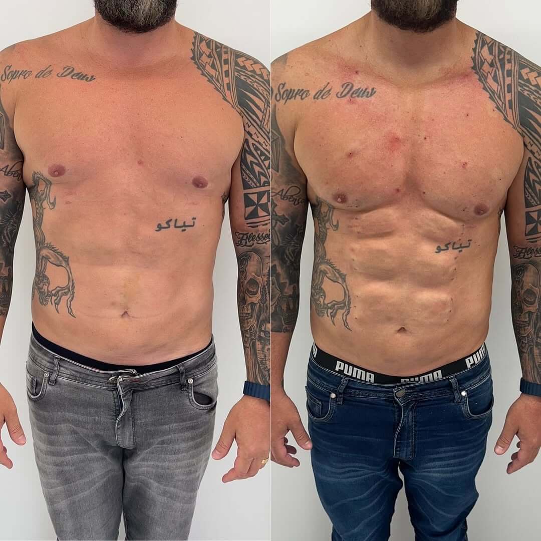 Harmonização-corporal-juiz-de-fora-dra-ana-flavia-freesz-nucleo-harmonizar (4)