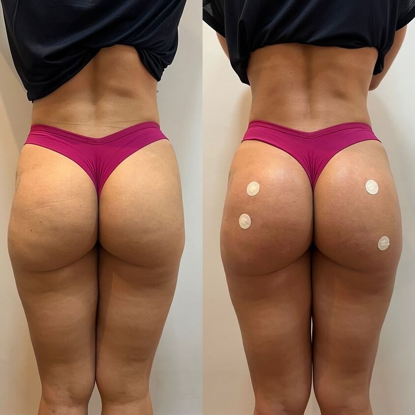 Harmonização-corporal-juiz-de-fora-dra-ana-flavia-freesz-nucleo-harmonizar (5)