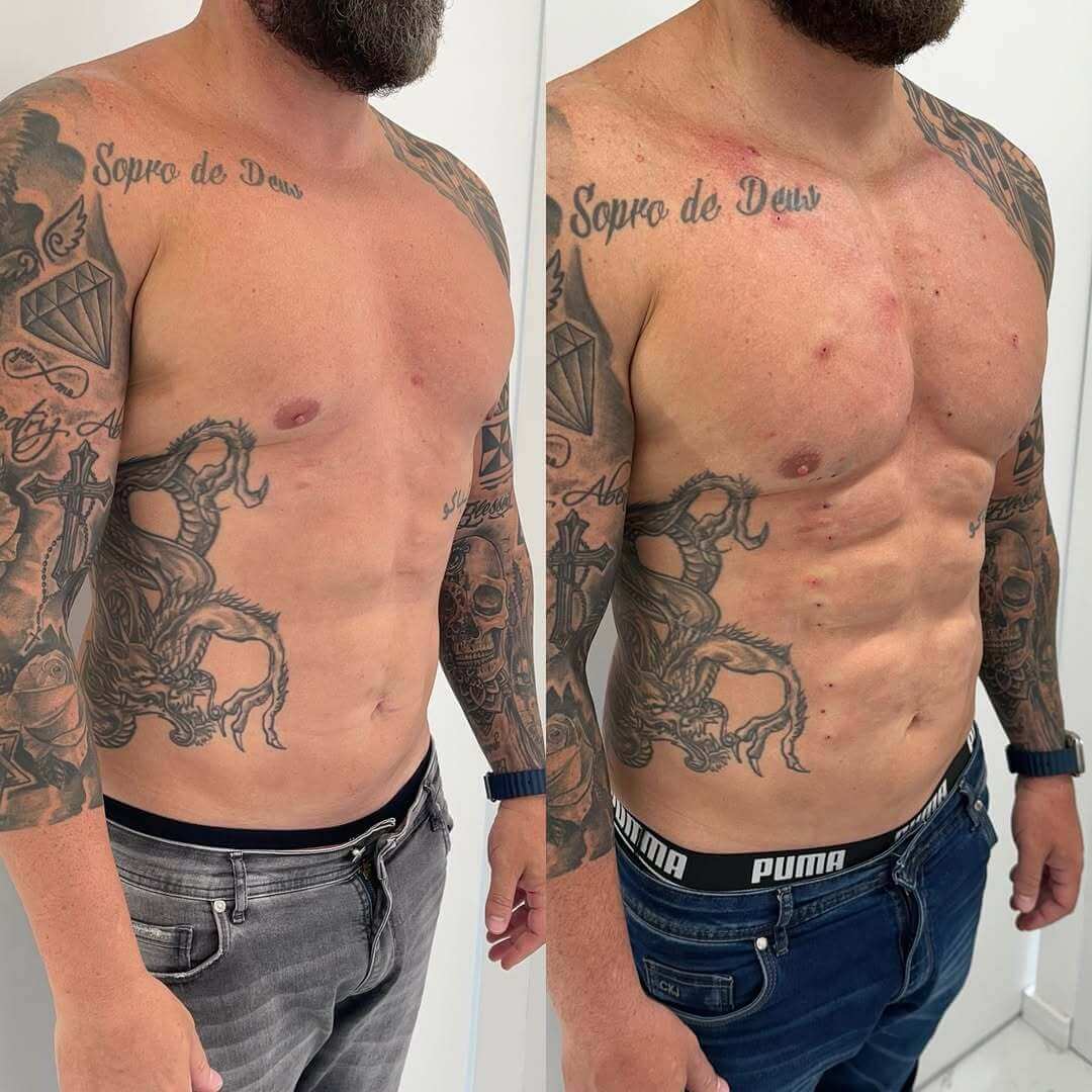 Harmonização-corporal-juiz-de-fora-dra-ana-flavia-freesz-nucleo-harmonizar (6)